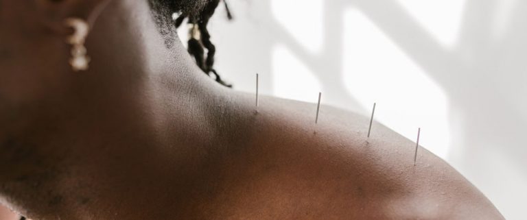 Acupuncture treatment